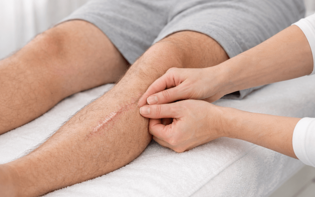 Arven hoito – Kuinka käsitellä arpea kotona?